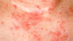 Nummular Eczema | National Eczema Association
