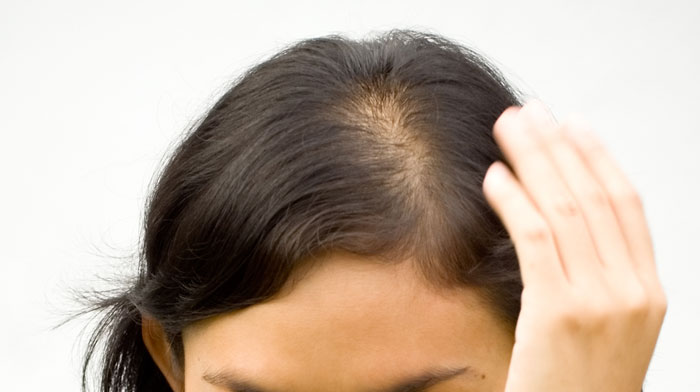Alopecia meaning