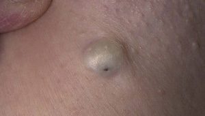 london dermatologist cysts