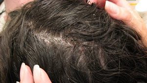 london dermatologist dandruff