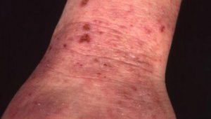london dermatologist eczema