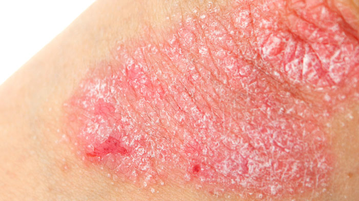 Psoriasis The London Dermatologist