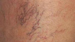 london dermatologist thread veins
