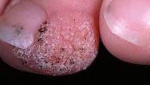 london dermatologist wart
