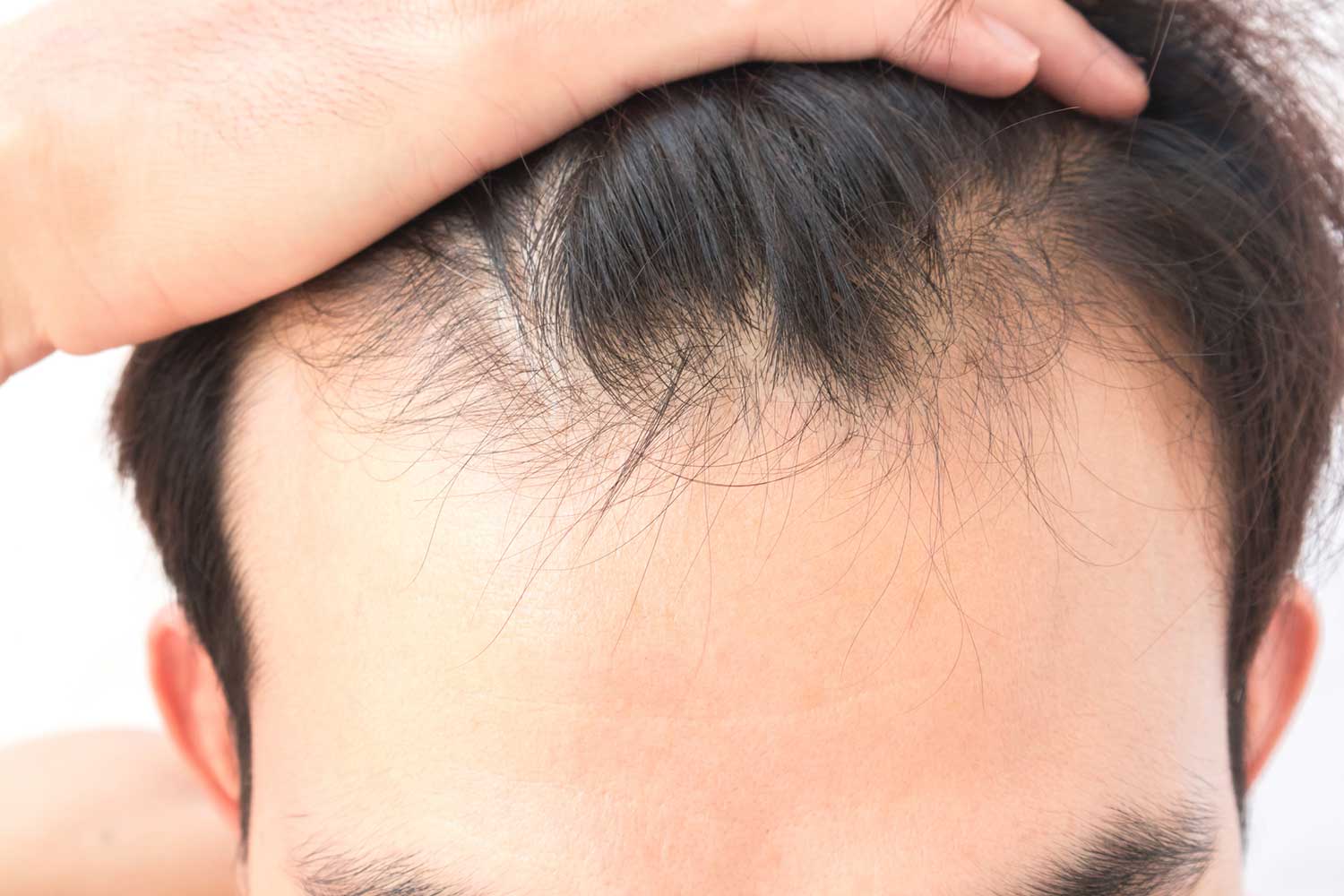 What Is Male-Pattern Hair Loss? - The London Dermatologist